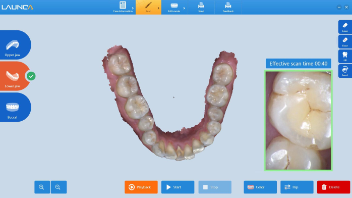 Launca-Intraoral-Scanner